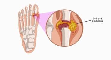 Gut hastalığında ayak ve diz ağrıları neden olur? – Prof. Dr. Hakan Özsoy (Ortopedi ve Travmatoloji)