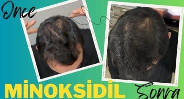 Dökülen saç nasıl çıkar | Minoksidil Sprey |  6 Aylık süreç | Saç dökülmesi çözümü