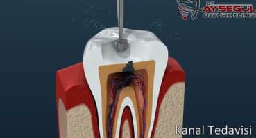 Kanal Tedavisi Nasıl Yapılır? | Endodonti