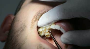 Tooth Extraction // Diş Çekimi Nasıl Yapılır ?