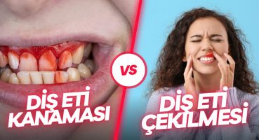 Diş Eti Kanaması Neden Olur.? Diş Eti Çekilmesi Tedavisi.