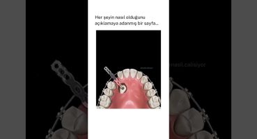 gömülü diş ameliyatı nasıl yapılır?
