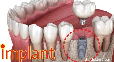 İmplant Tedavisi Nasıl Yapılır? | Tek Diş