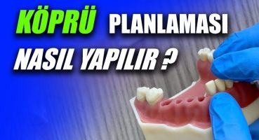 Protez Planlaması Nasıl Yapılır? Ante Kuralı Nedir?