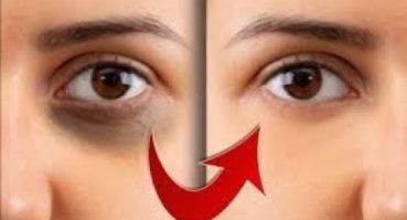 (Göz altı morluğu neden olur) Göz altı morlukların dan kurtulmanın etkili yolları