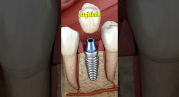 İmplant Diş Nasıl Yapılır #implant 🦷