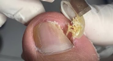 Deep nail cleaning