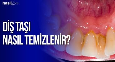Diş Taşı neden olur ve nasıl temizlenir? | Sağlık | Nasil.com