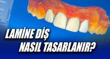 Lamine Diş Tasarımı Nasıl Yapılır? Dijital Diş Tasarımı, Gülüş Tasarımı Dijitalde Nasıl Yapılır?