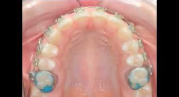 Diş tellerinin yanuk çıkan dişleri nasıl düzeltir?