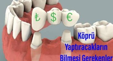 Diş köprüsü nasıl yapılır? Bilmeniz Gereken 4 Aşama