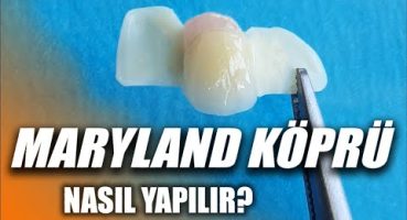 Zirkonyum Destekli MARYLAND Köprü Nasıl Yapılır? Estetik Diş, İmplant vs Köprü